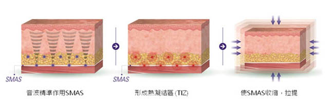 音波精準作用SMAS,形成熱凝結區(TIZ),使SMAS收縮拉提